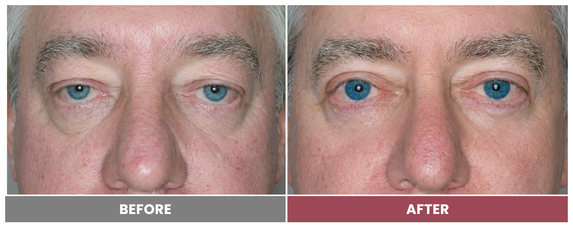 PTOSIS REPAIR - Case 12